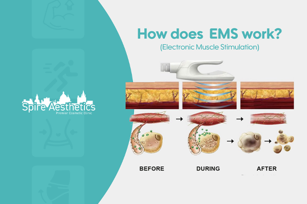 EMS treatment for post pregnancy weight loss treatment Corby