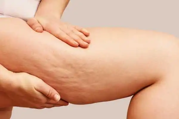 Image of woman showing leg with cellulite Corby