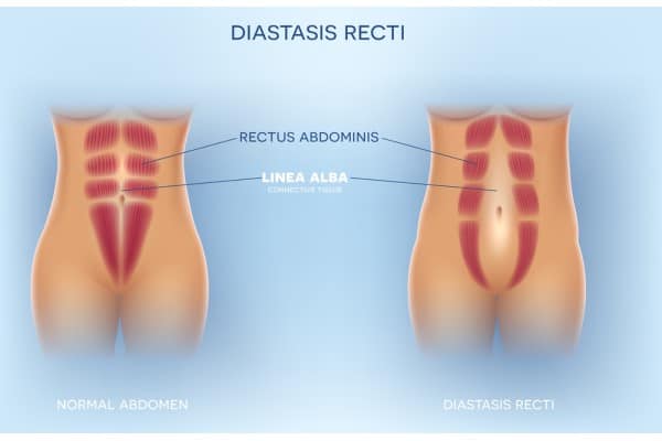 What Non-Surgical Options Are Available for Diastasis Recti Corby?