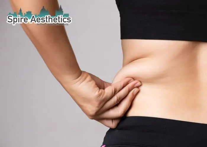 Image of woman pinching fat on their hips Corby. Fat Freezing treatment