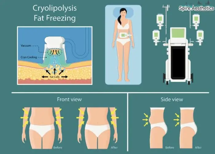 Fat freezing treatment Corby benefits for competitions to remove stubborn fat deposits.