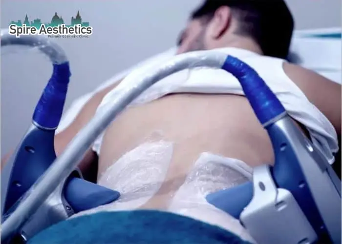 Man having fat freezing treatment done on love handles before a competitions Corby to create a sculpted look.