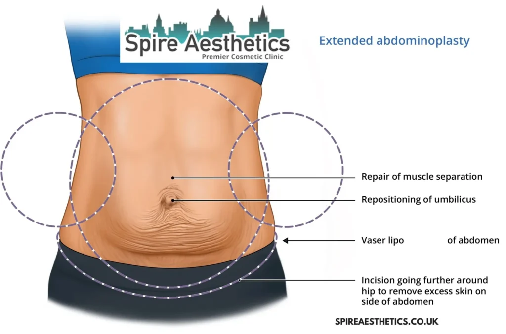 Understanding Loose Skin After Gastric Band Corby Surgery and HIFU Treatment