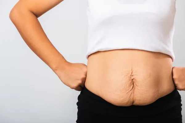 Image of a woman's stomach after weight loss with sagging skin following a gastric band Corby