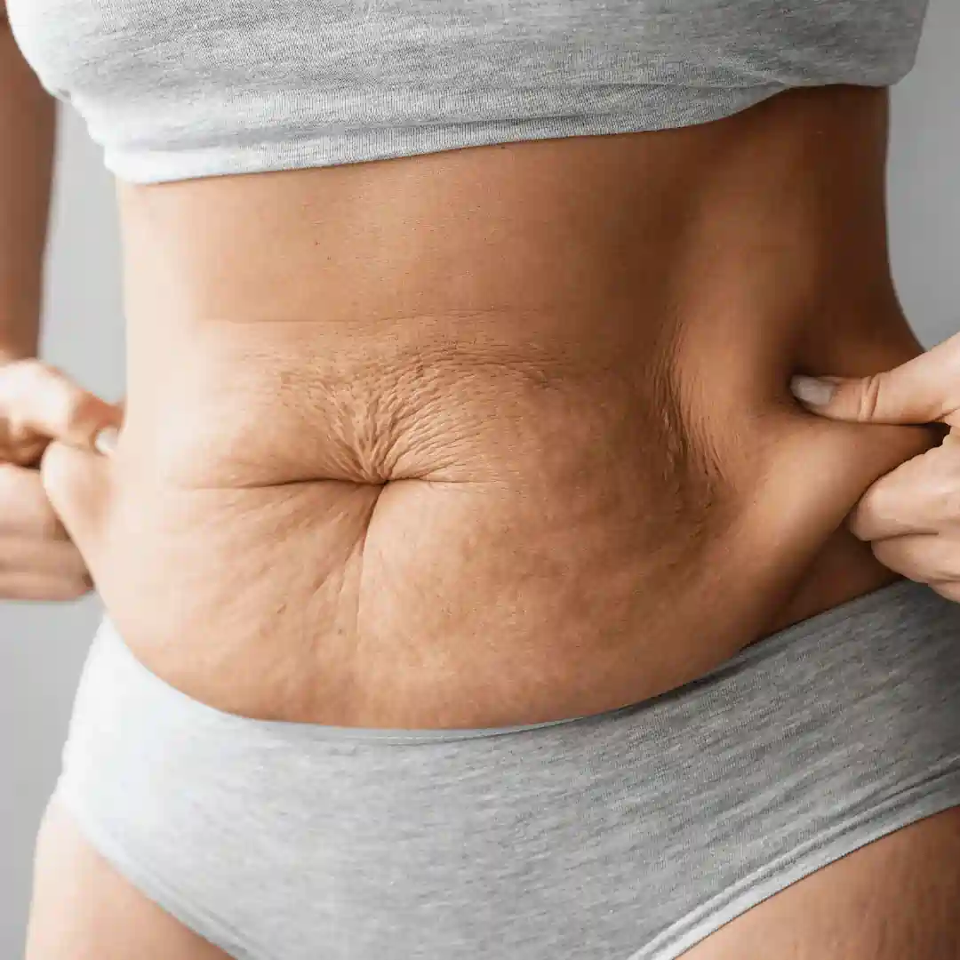 Is It Normal to Have Loose Skin After Pregnancy Corby?