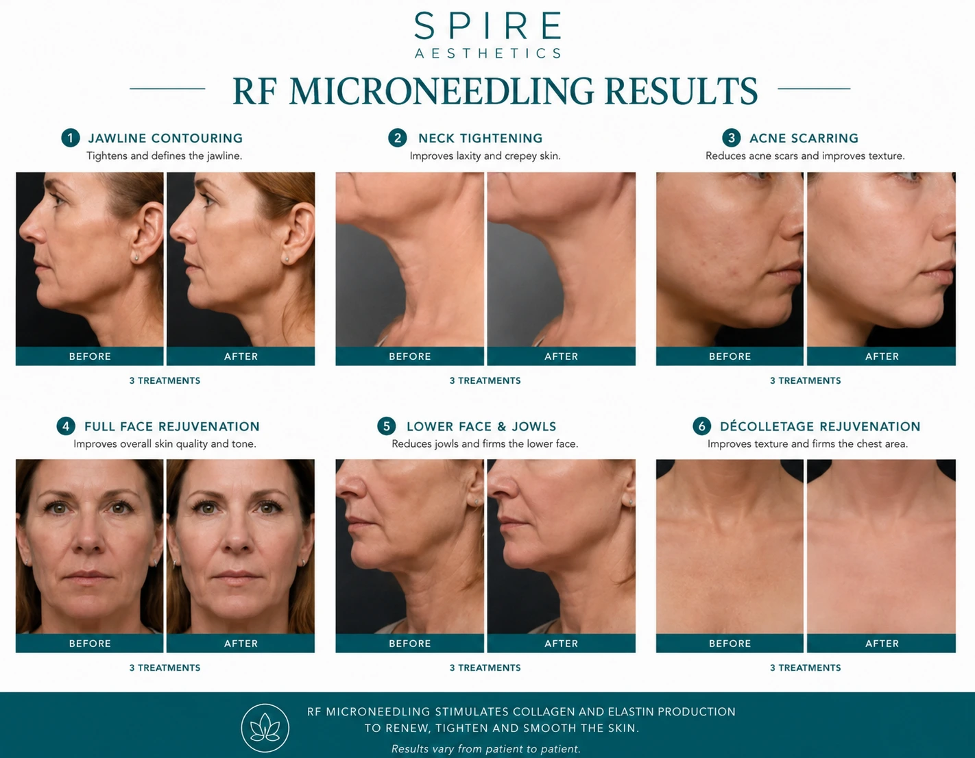 RF Microneedling Skin tightening Corby results