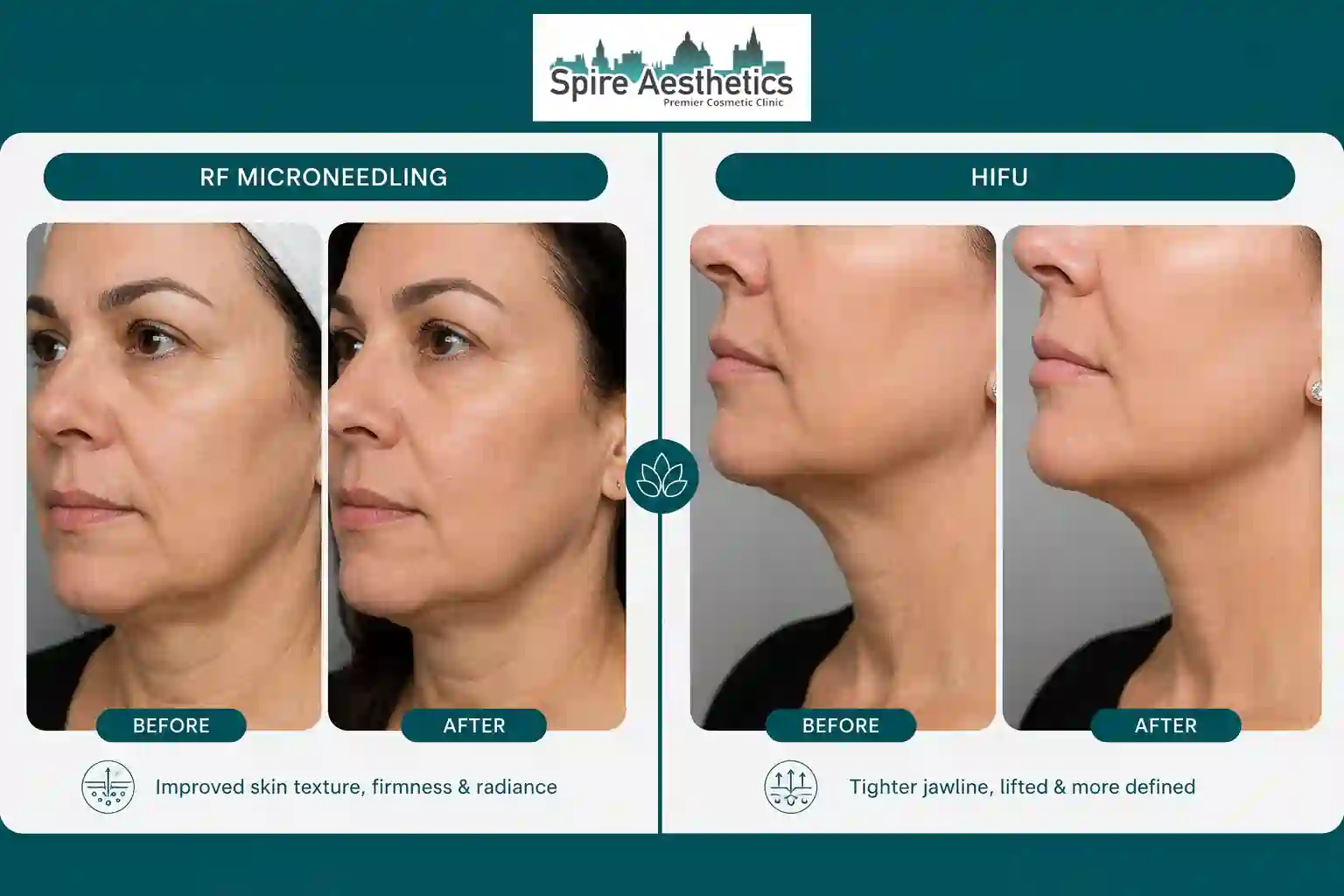 Can RF Microneedling and HIFU Be Combined Corby?