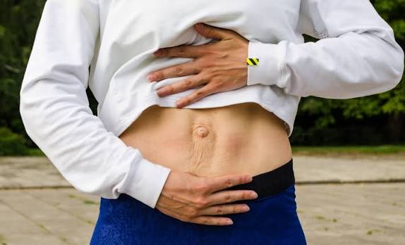 When Could Diastasis Recti Be the Missing Piece of the Puzzle Corby?
