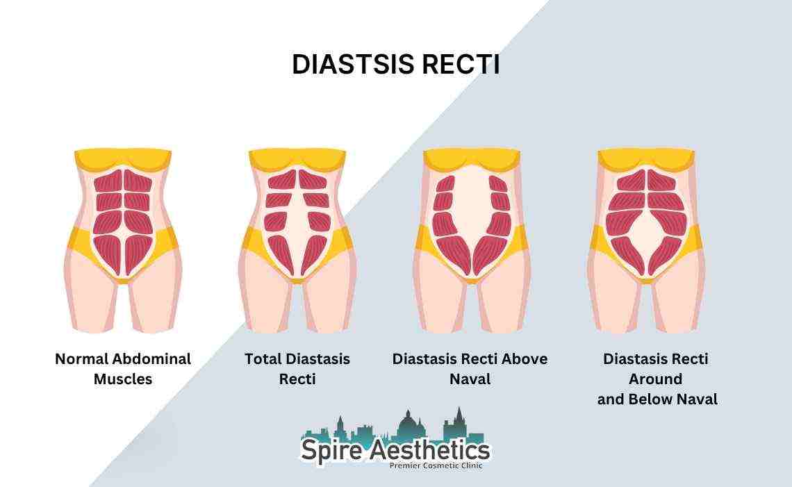 Is Non-Surgical Diastasis Recti Treatment Right for You? Common Concerns Answered Corby